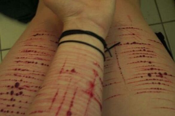 SELF-CUTTING Una Tragedia Más Para Adolescentes