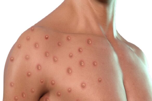 Monkeypox Can Spread Through Contaminated Clothing